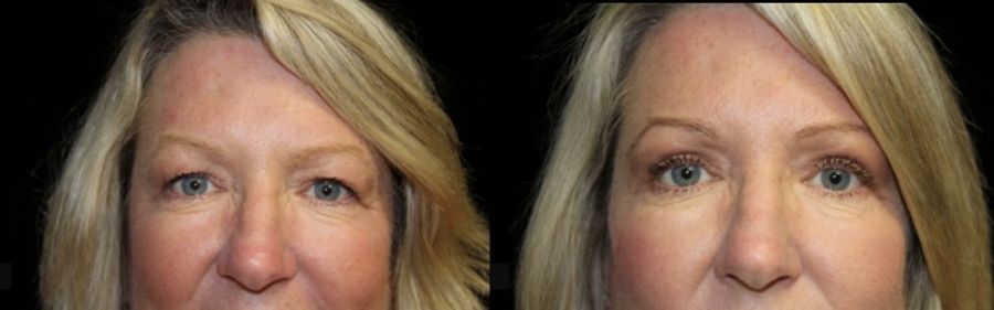 Before and after Blepharoplasty case 32761