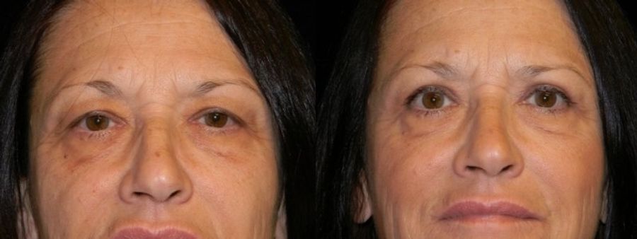 Before and after Blepharoplasty case 32760