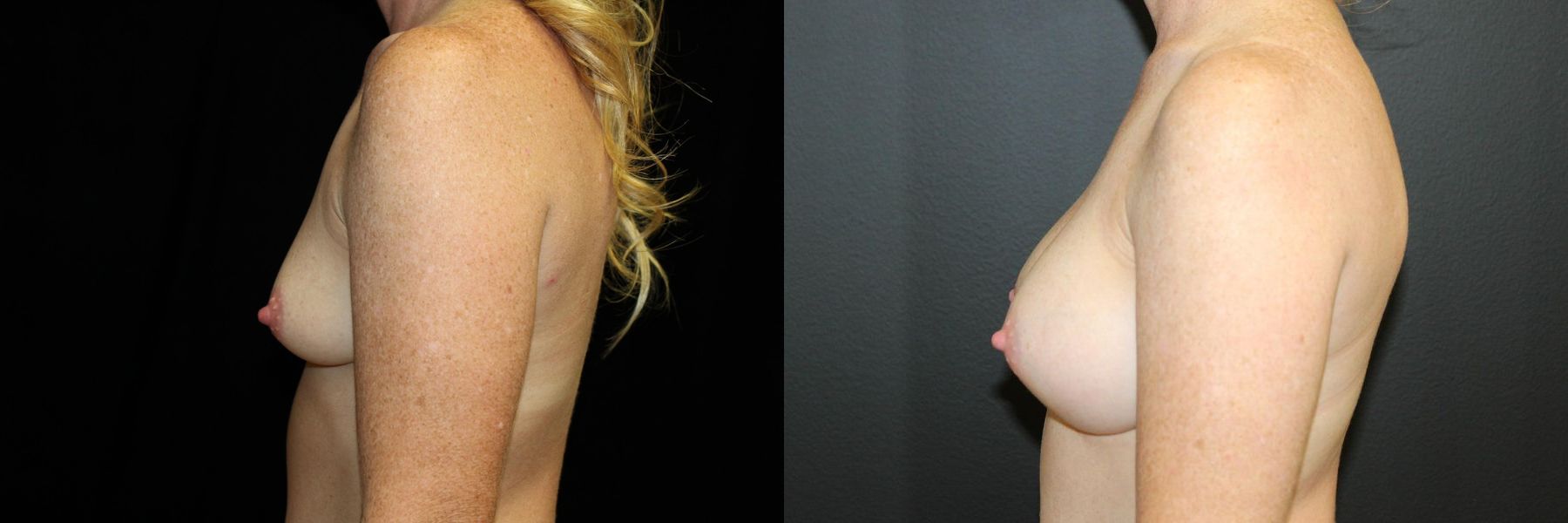 Before and after Breast Augmentation case 32589 - Angle 3