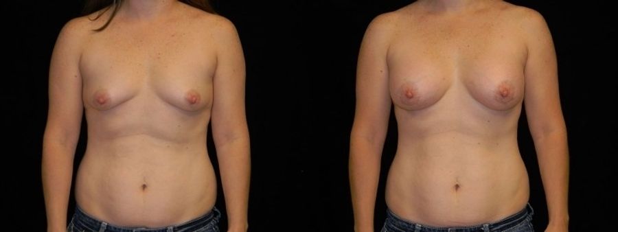 Before and after Breast Augmentation case 32698