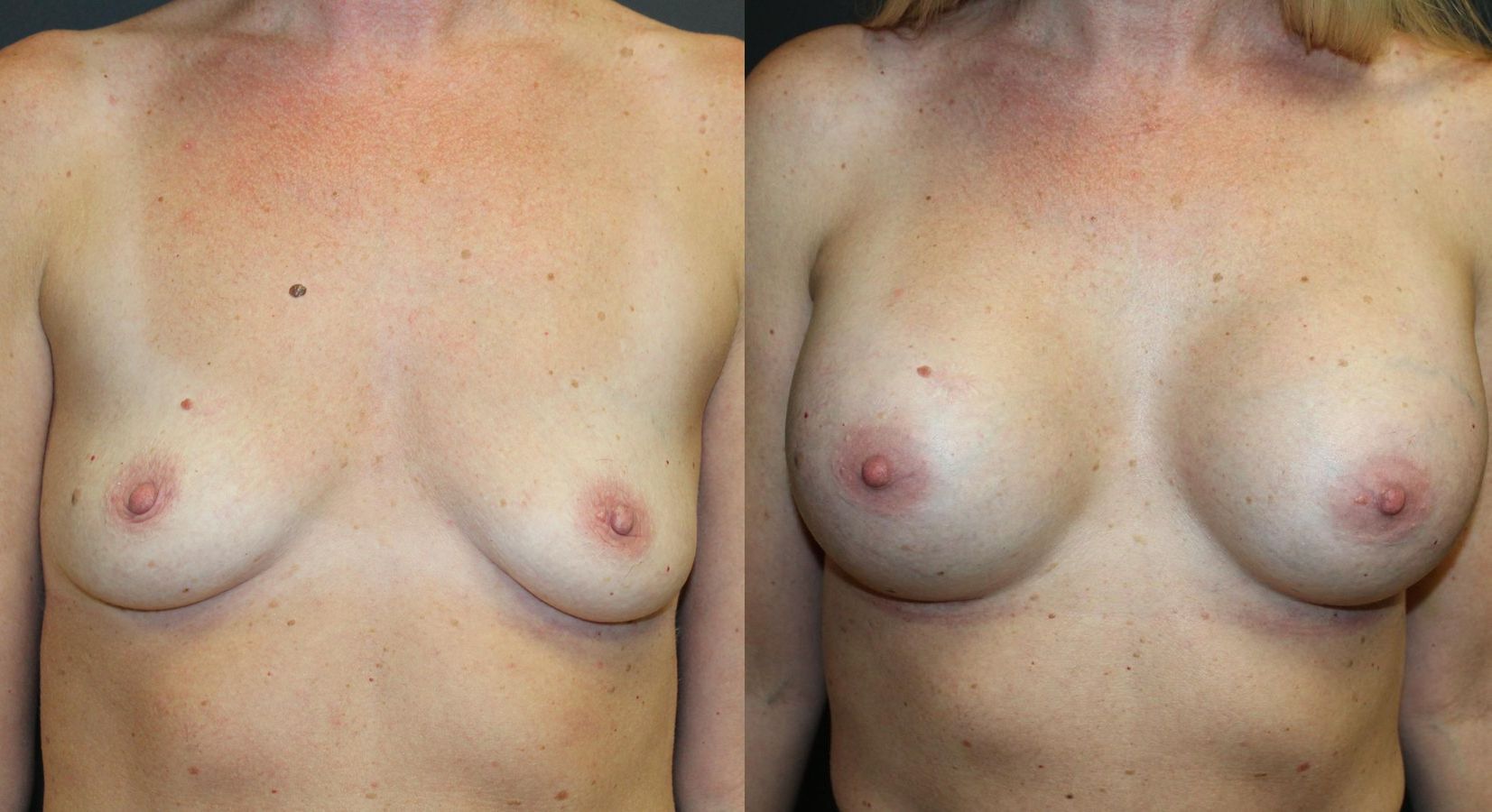 Before and after Breast Augmentation case 32615
