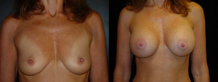 Before and after Breast Augmentation case 32705