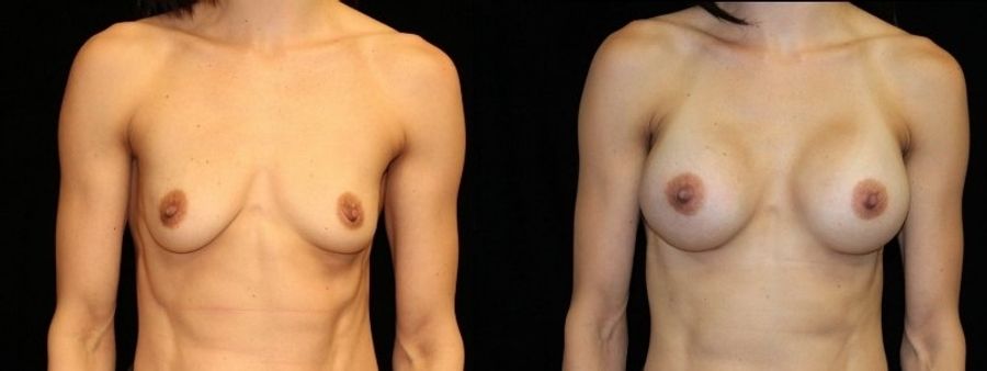 Before and after Breast Augmentation case 32646