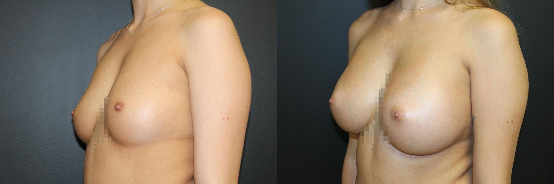 Before and after Breast Augmentation case 32588 - Angle 3