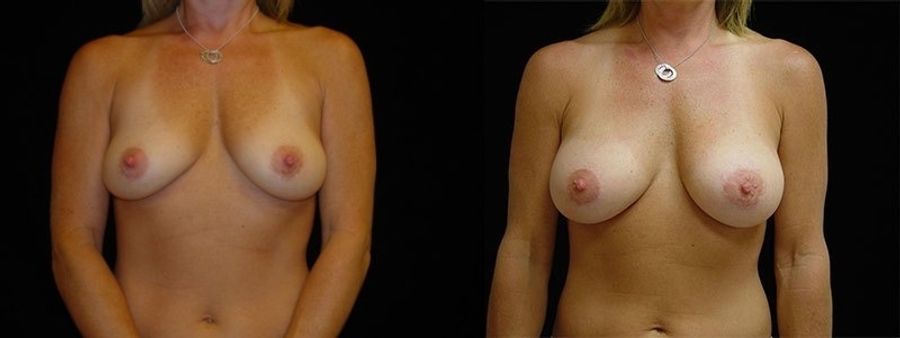 Before and after Breast Augmentation case 32685