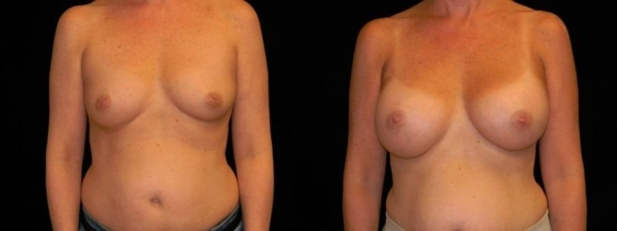 Before and after Breast Augmentation case 32704