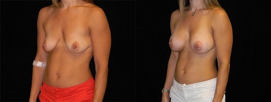 Before and after Breast Augmentation case 32676 - Angle 2