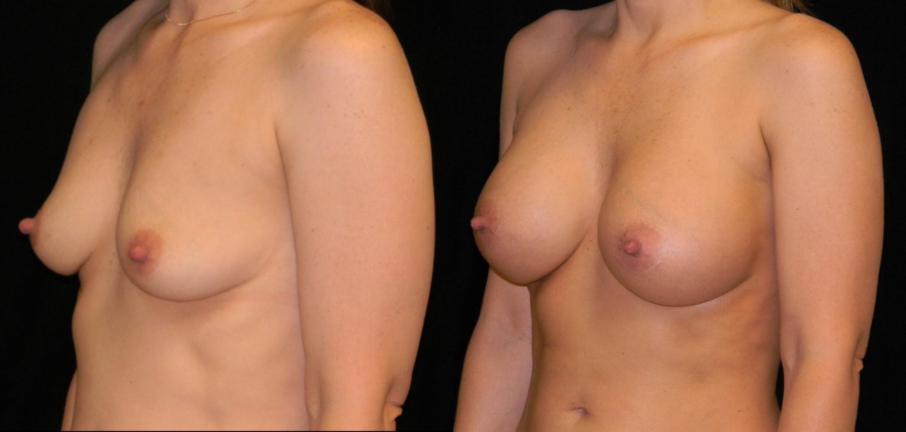 Before and after Breast Augmentation case 32586 - Angle 2