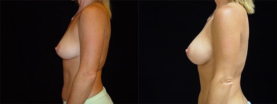 Before and after Breast Augmentation case 32685 - Angle 2