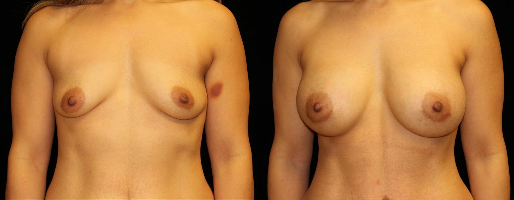 Before and after Breast Augmentation case 32614