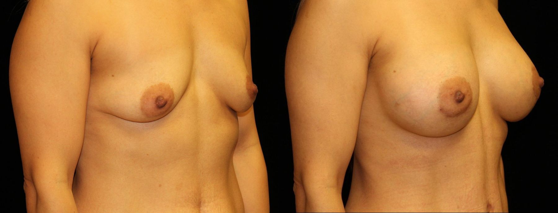 Before and after Breast Augmentation case 32614 - Angle 2