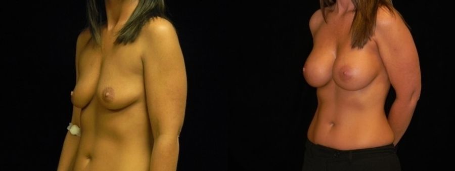 Before and after Breast Augmentation case 32686 - Angle 2