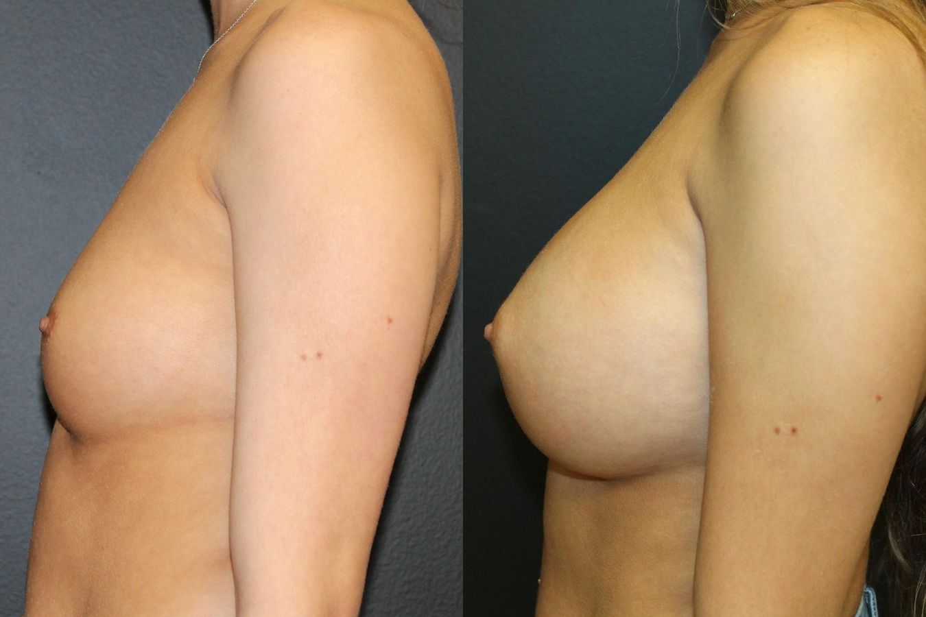 Before and after Breast Augmentation case 32588 - Angle 2