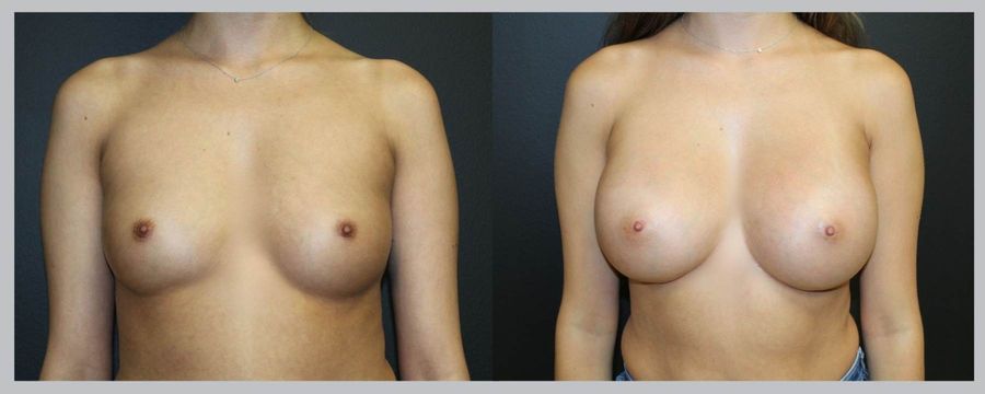 Before and after Breast Augmentation case 32604