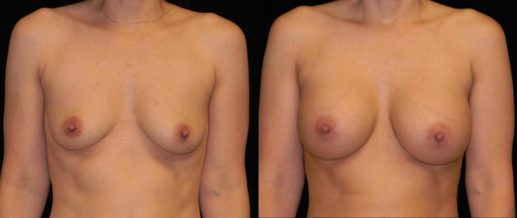 Before and after Breast Augmentation case 32586