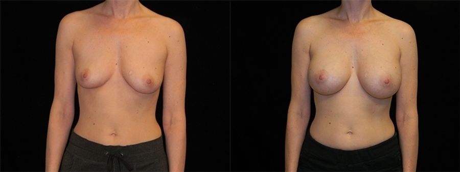 Before and after Breast Augmentation case 32684