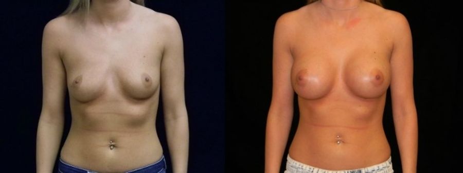 Before and after Breast Augmentation case 32670