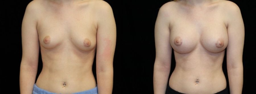 Before and after Breast Augmentation case 32669