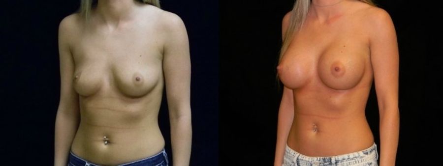Before and after Breast Augmentation case 32670 - Angle 2