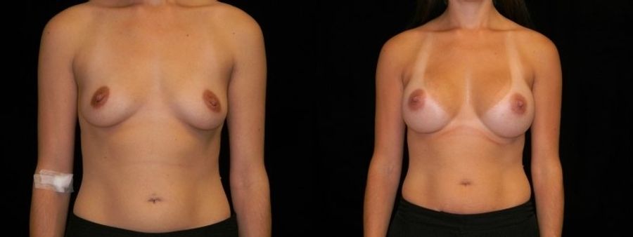 Before and after Breast Augmentation case 32652