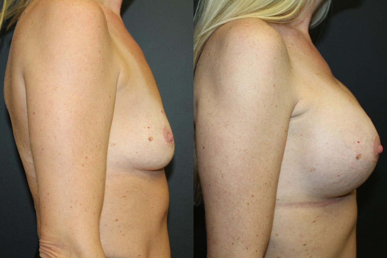 Before and after Breast Augmentation case 32615 - Angle 3