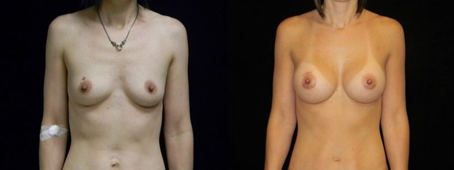 Before and after Breast Augmentation case 32683