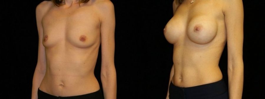 Before and after Breast Augmentation case 32690 - Angle 2