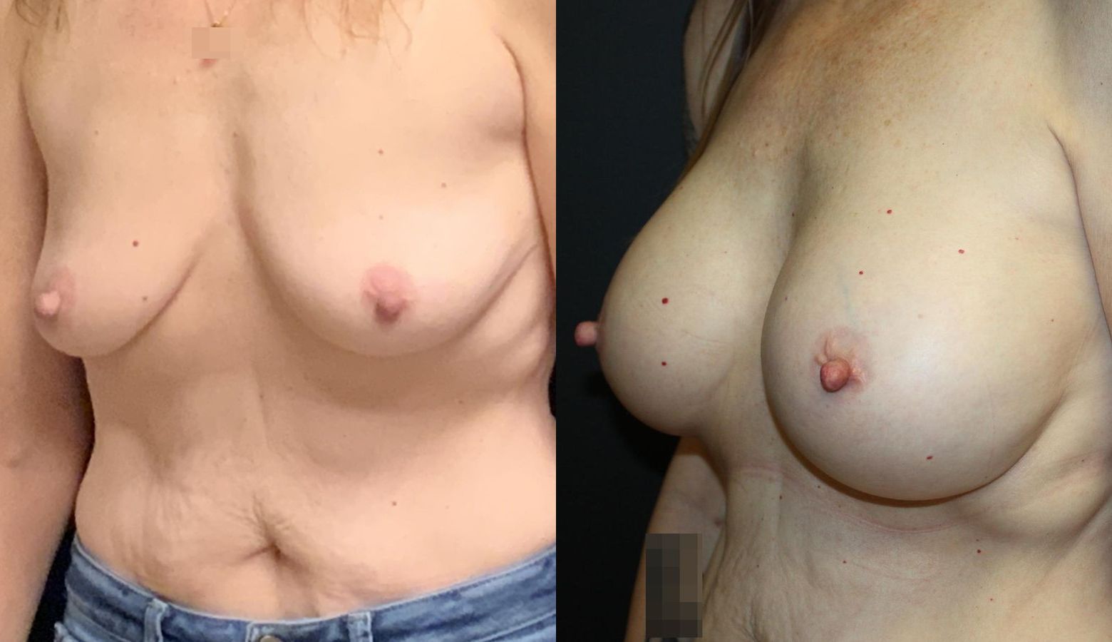 Before and after Breast Augmentation case 32714 - Angle 2