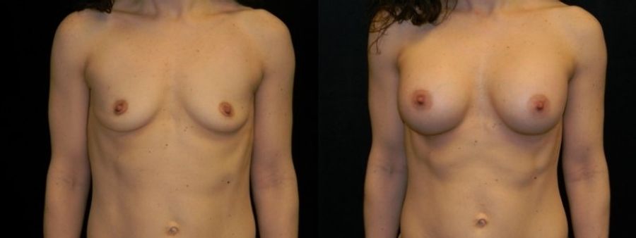 Before and after Breast Augmentation case 32621