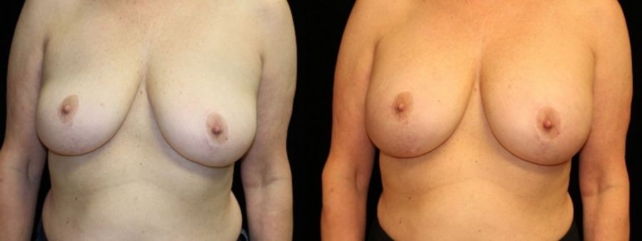 Before and after Breast Augmentation case 32663