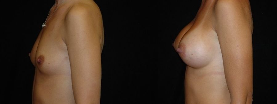 Before and after Breast Augmentation case 32679 - Angle 2