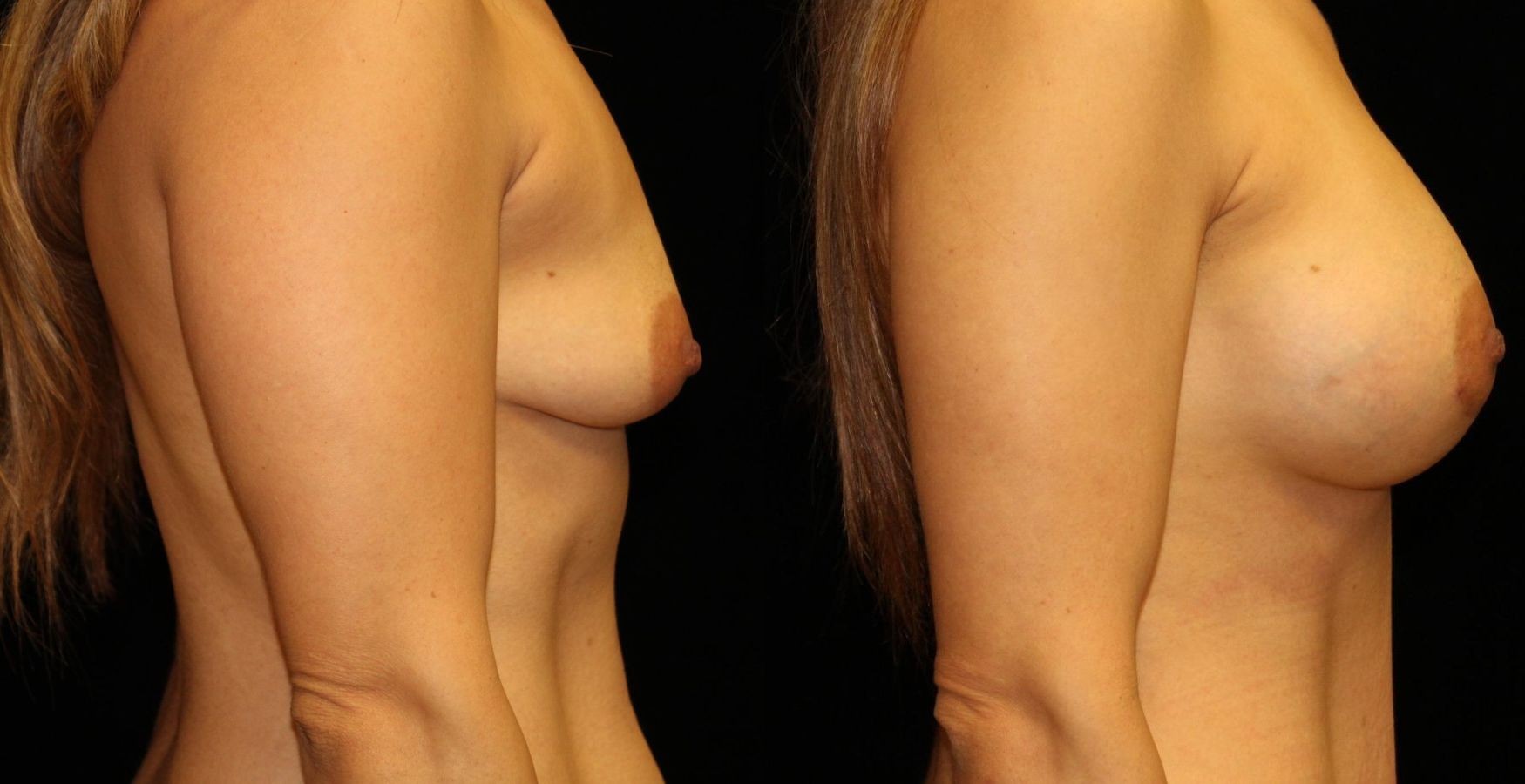 Before and after Breast Augmentation case 32614 - Angle 3