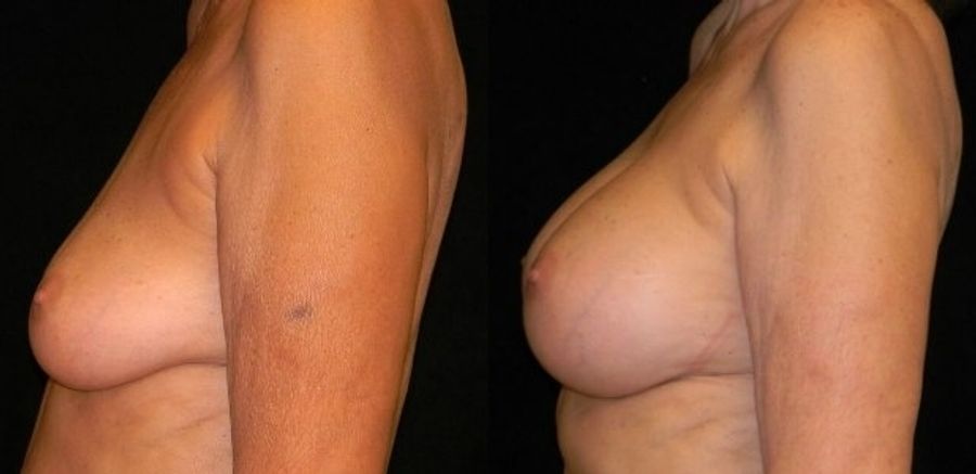 Before and after Breast Augmentation case 32677 - Angle 2