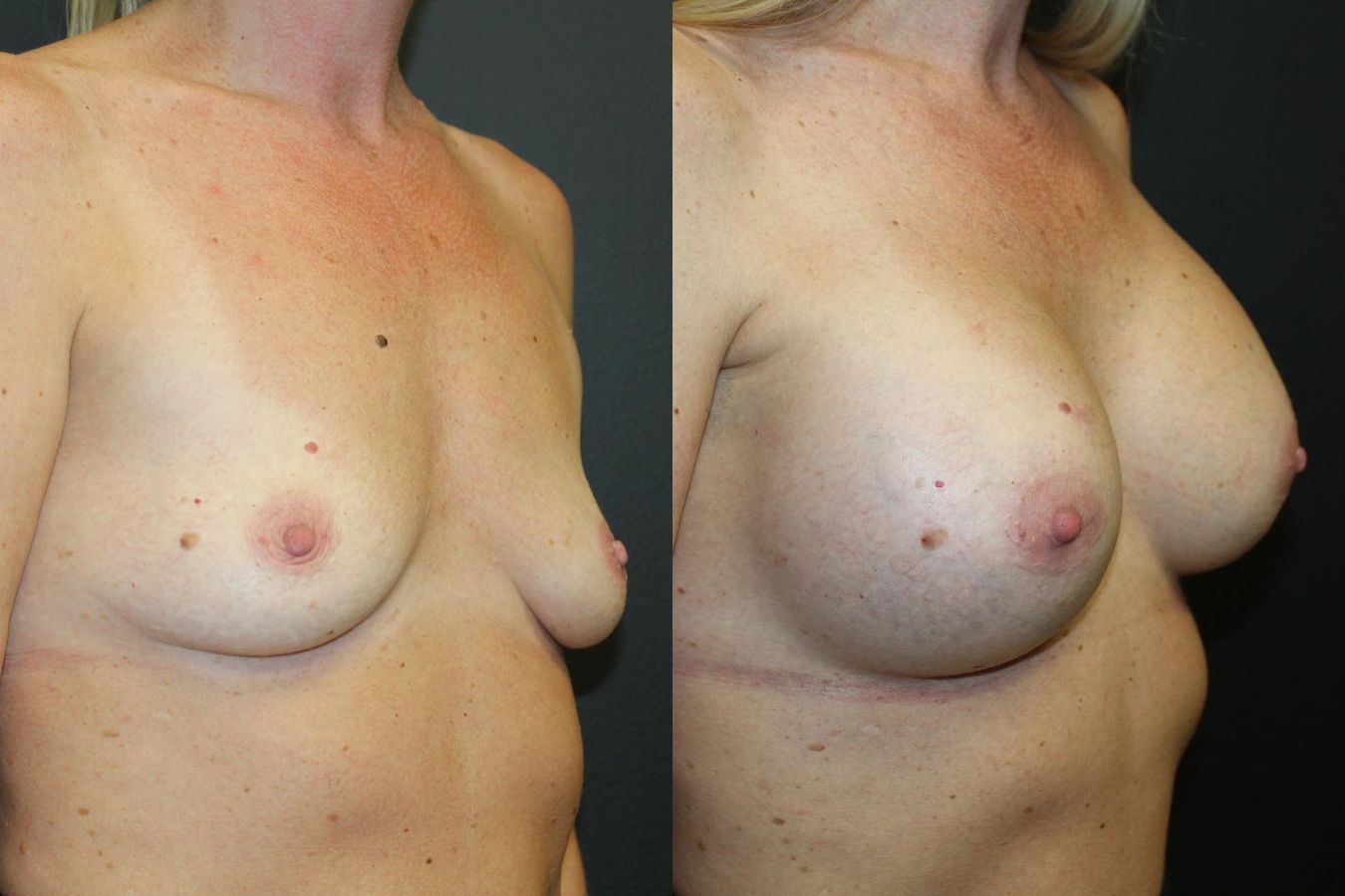 Before and after Breast Augmentation case 32615 - Angle 2