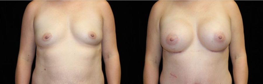 Before and after Breast Augmentation case 32666
