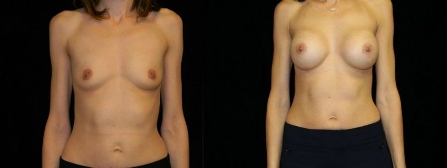 Before and after Breast Augmentation case 32690