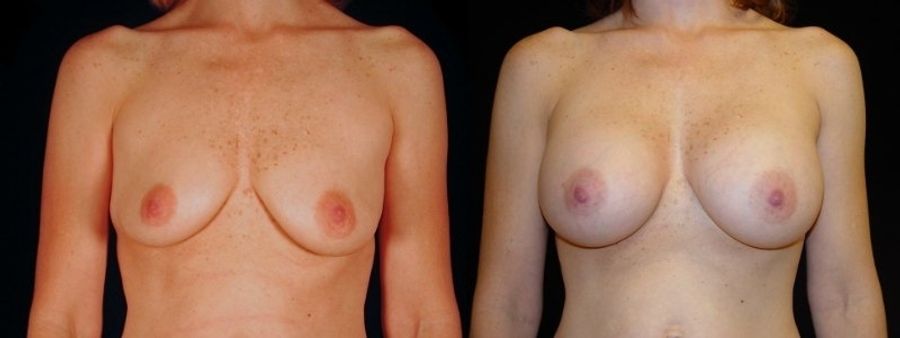 Before and after Breast Augmentation case 32709