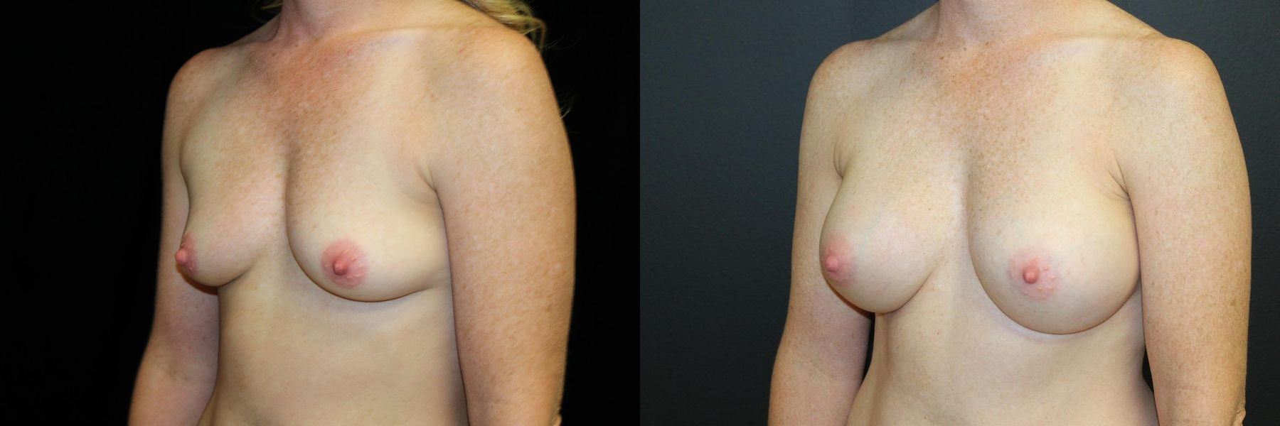 Before and after Breast Augmentation case 32589 - Angle 2