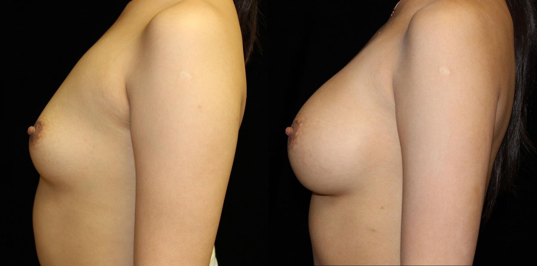 Before and after Breast Augmentation case 32587 - Angle 2