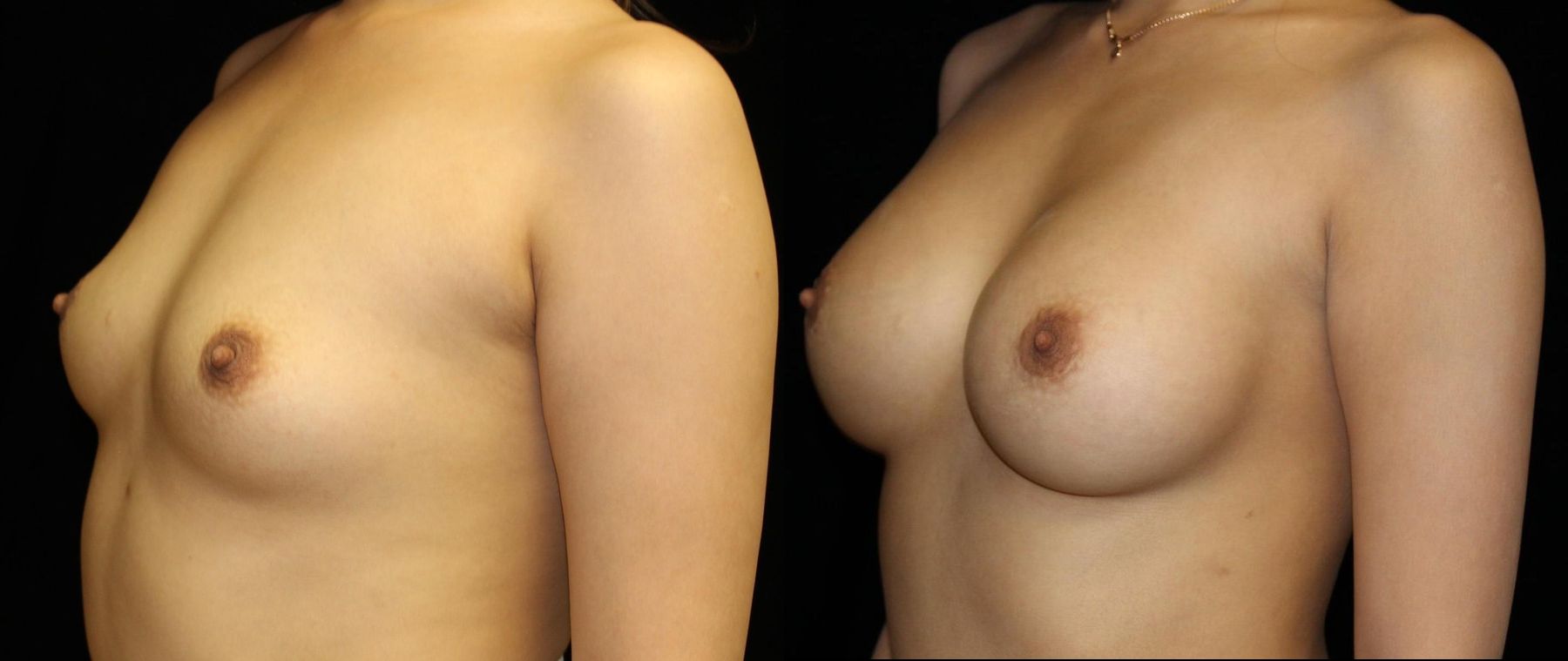 Before and after Breast Augmentation case 32587 - Angle 3