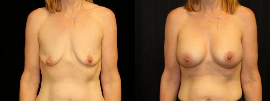 Before and after Breast Augmentation case 32633