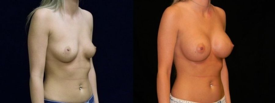 Before and after Breast Augmentation case 32670 - Angle 3