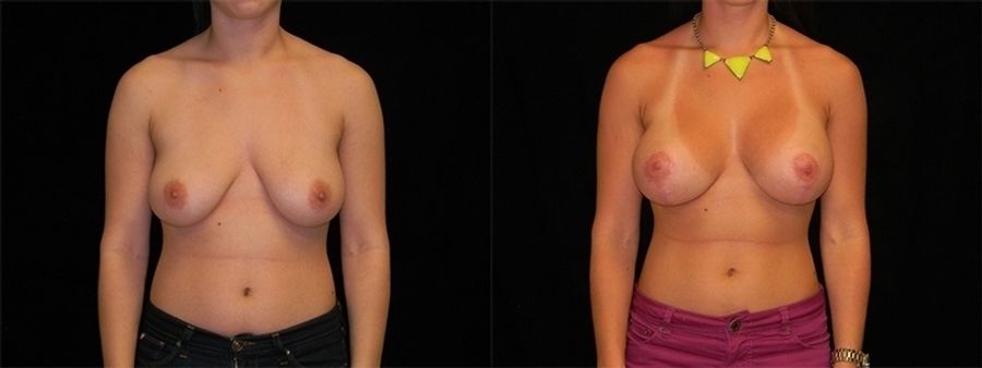 Before and after Breast Augmentation with Lift case 32583