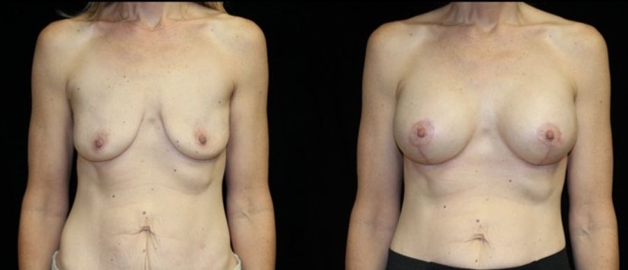 Before and after Breast Augmentation with Lift case 32631
