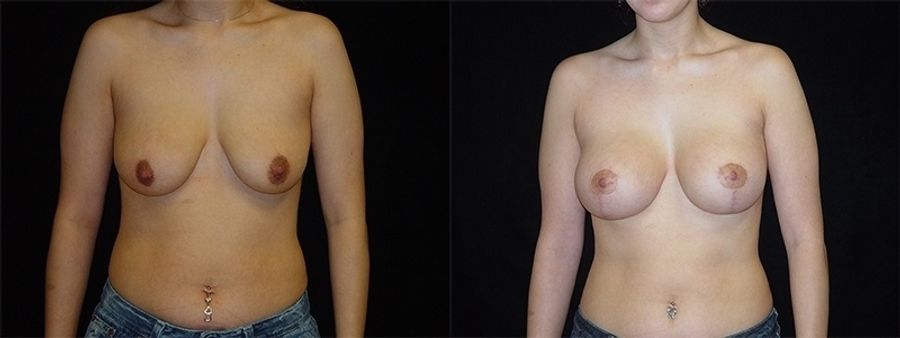 Before and after Breast Augmentation with Lift case 32635