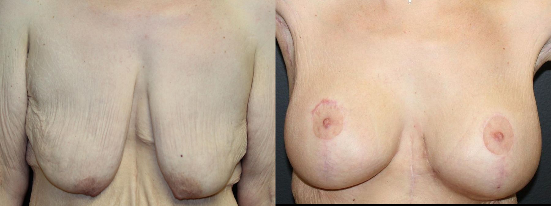 Before and after Breast Augmentation with Lift case 32592