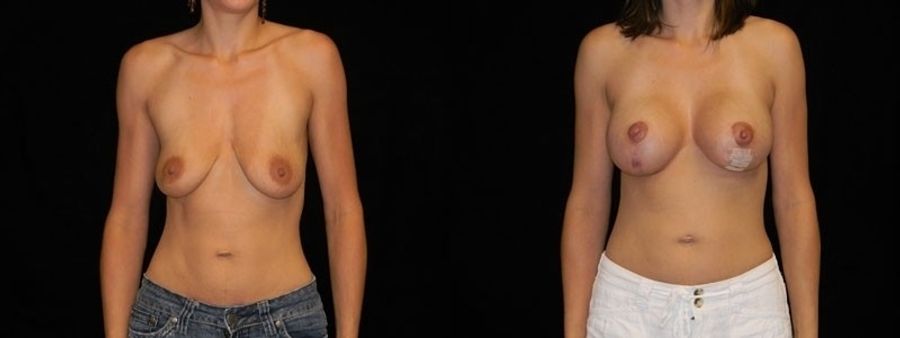 Before and after Breast Augmentation with Lift case 32650