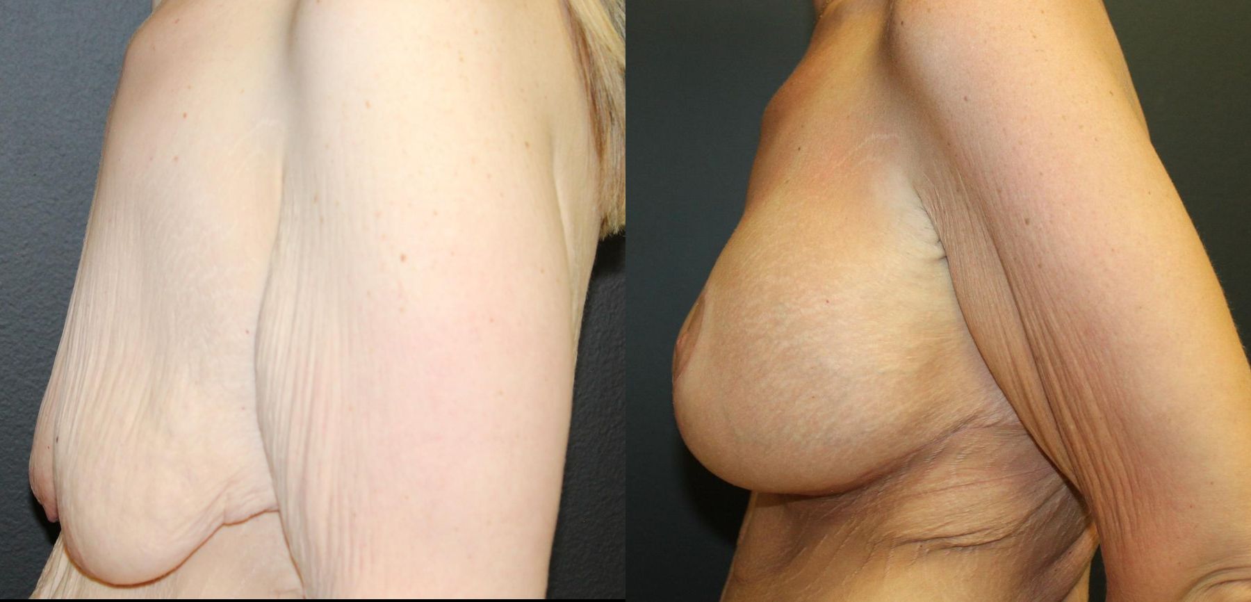 Before and after Breast Augmentation with Lift case 32592 - Angle 3