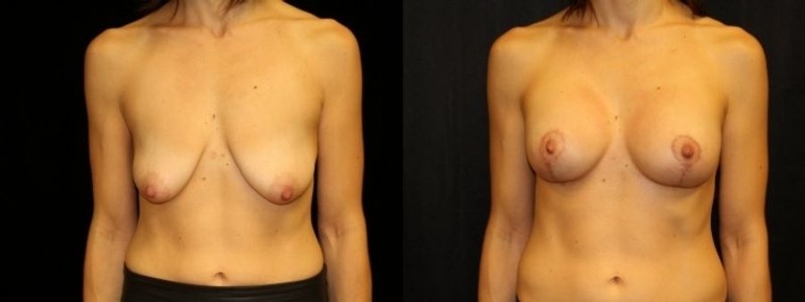 Before and after Breast Augmentation with Lift case 32609