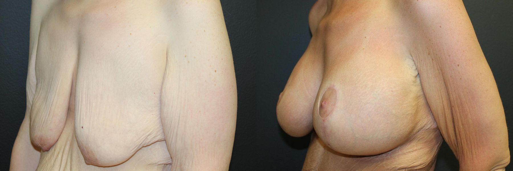 Before and after Breast Augmentation with Lift case 32592 - Angle 2